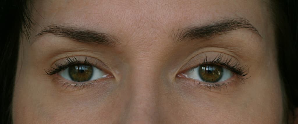 Ptosis Correction Korea Guide